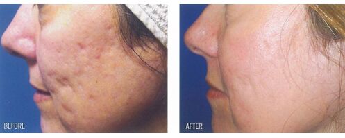 Antes y después de aplicar el dispositivo láser en la piel con cicatrices. 
