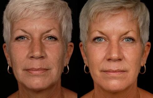 El resultado del tratamiento con láser de la piel del rostro reducción de las arrugas. 