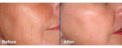 Piel facial antes y después del procedimiento de rejuvenecimiento con láser. 