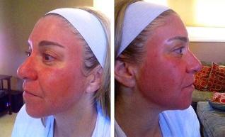 Enrojecimiento facial después del rejuvenecimiento con láser. 