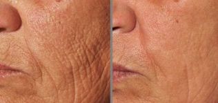 foto antes y después del rejuvenecimiento fraccional de la piel