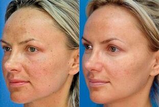 foto antes y después del rejuvenecimiento de la piel con el dispositivo